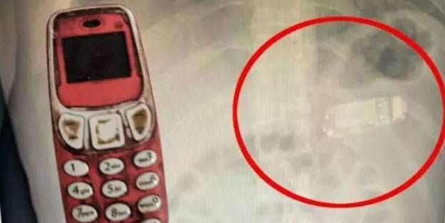 Nokia 3310'u yuttu! Midesinde 4 gün boyunca kaldı