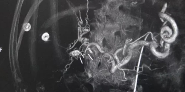 Nükleer Tıpta uzman isim duyurdu! TARE tedavisi dahil kanserle mücadelede savaş açan yeni silah projesi