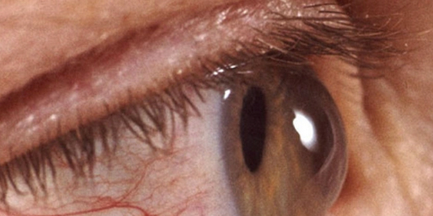 O ülkede büyük panik! Kırmızı göz salgını nedeniyle eğitime ara verildi