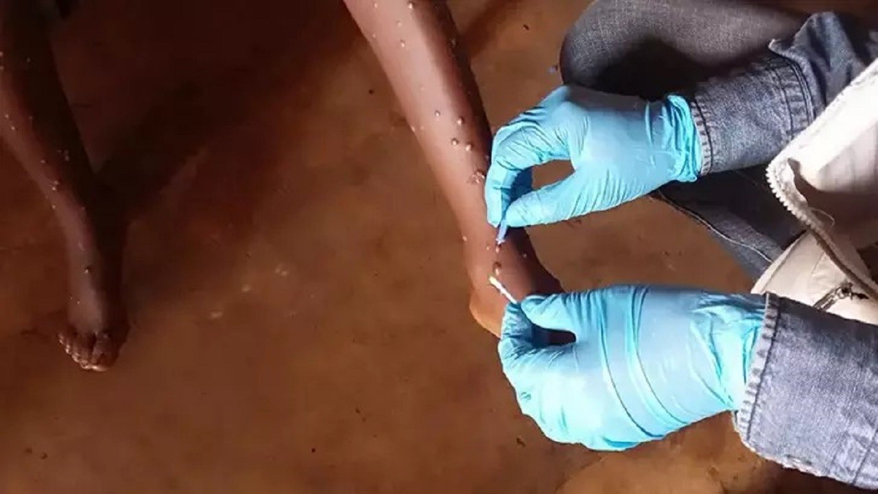 o ülkede ilk kez maymun çiçeği tespit edildi