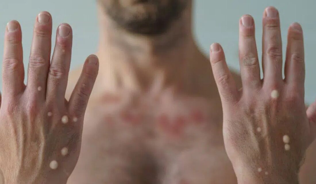 O ülkede ilk maymun çiçeği vakası