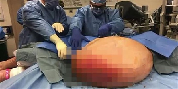 Obez zannedilen kadın karnından çıkana ...