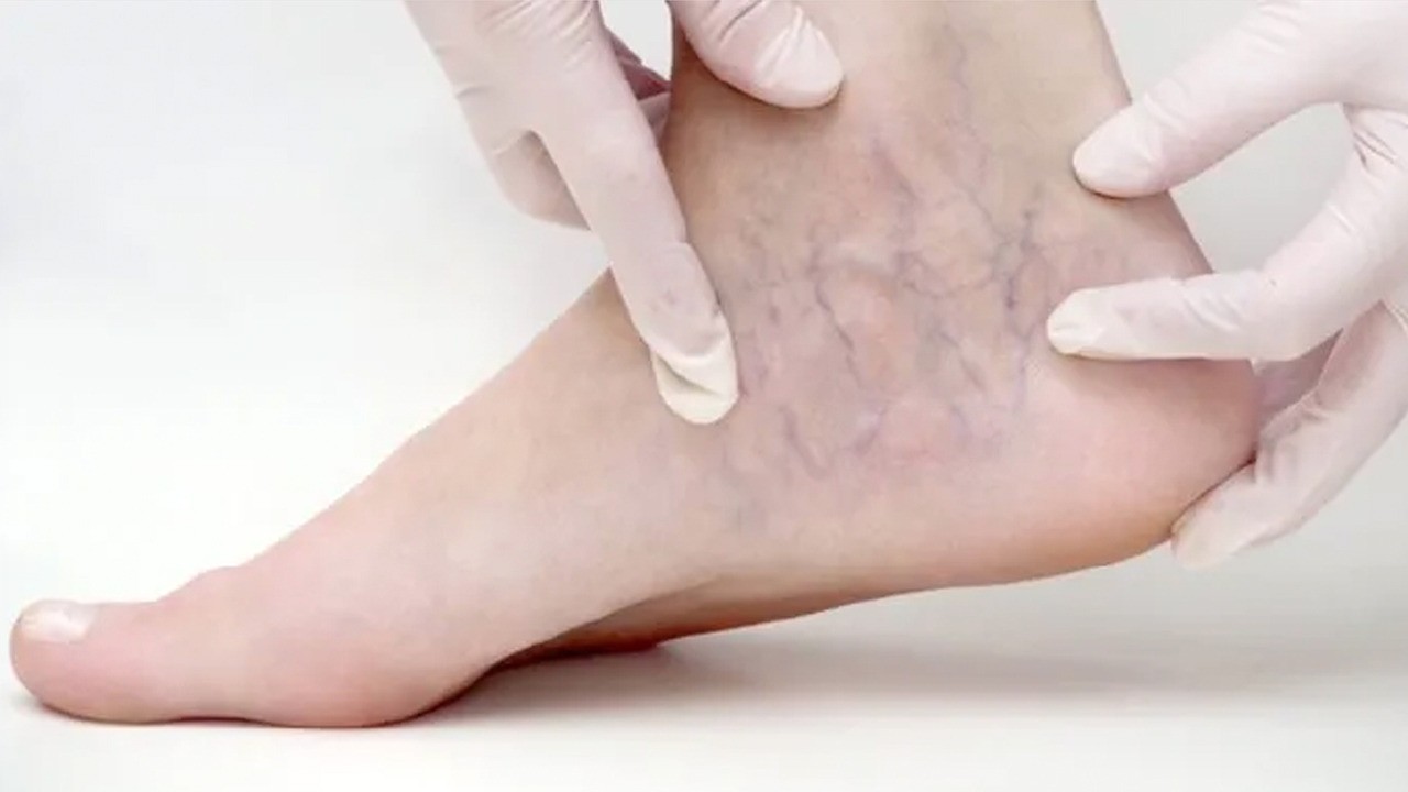 Ödem nedir? Ödem nasıl atılır? Ödem sorunu olanlar bu yöntemleri denediniz mi?