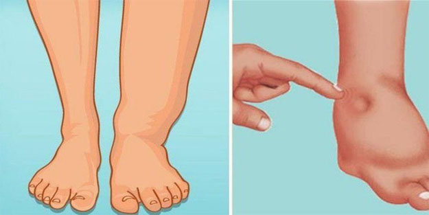 Ödem nedir? Vücuttan ödem atmanın yolları nelerdir?
