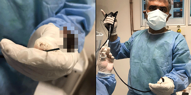 Öksürük şikayetiyle doktora gitti, akciğerlerinden kabak çekirdeği çıktı