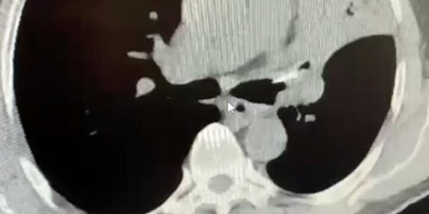 Öksürük şikayetiyle gitti akciğerinden çıkan şey şok etti