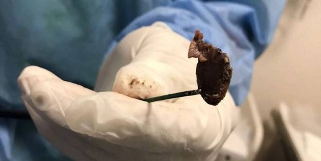 Öksürük şikayetiyle hastaneye giden kadının akciğerinden bakın ne çıktı