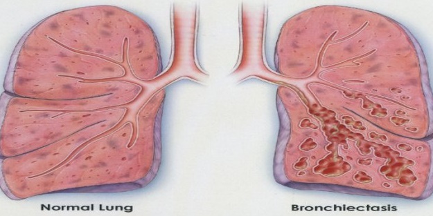 Öksüz hastalığını biliyor musunuz?