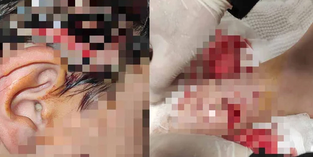 Okula giderken 8 köpek saldırdı 80 dikiş atıldı!