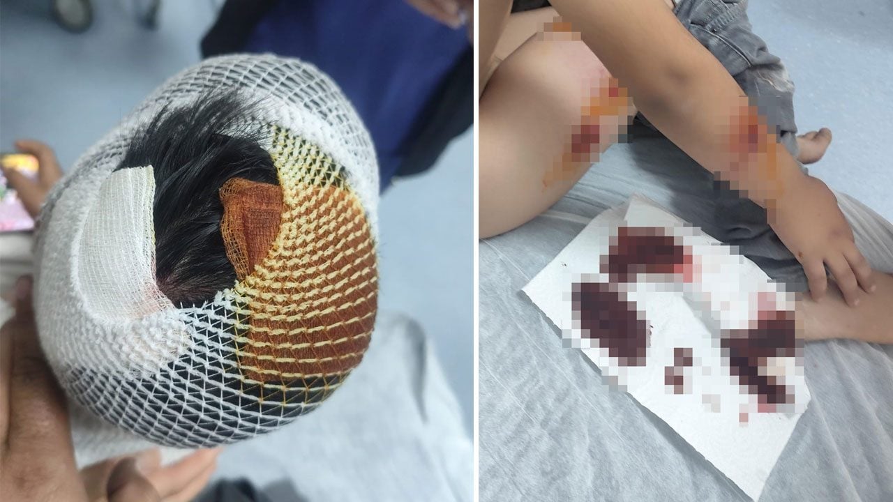 Okuldan çıkan çocuğa sokak köpekleri saldırdı: Kafasına 15 dikiş atıldı