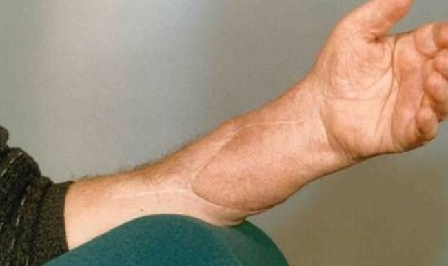 Ölen hastanın eli başkasına nakledildi