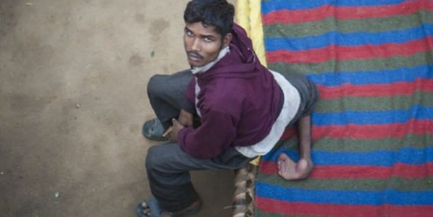 Ölen ikizinin bacaklarıyla yaşıyor