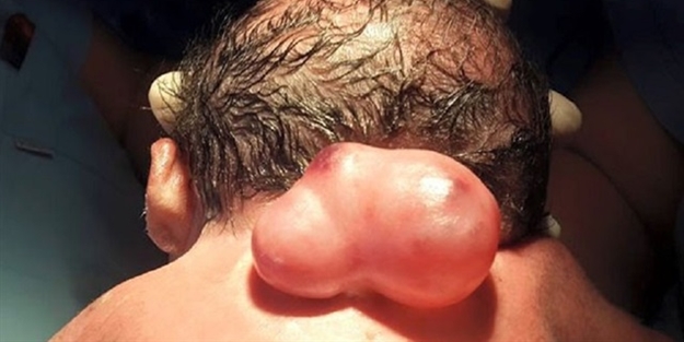 Omuriliği dışarıda doğdu