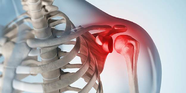 Omuz sıkışma sendromu yaşam kalitesini bozuyor