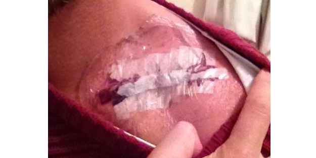 Omzundaki platini çıkarttıktan sonra...