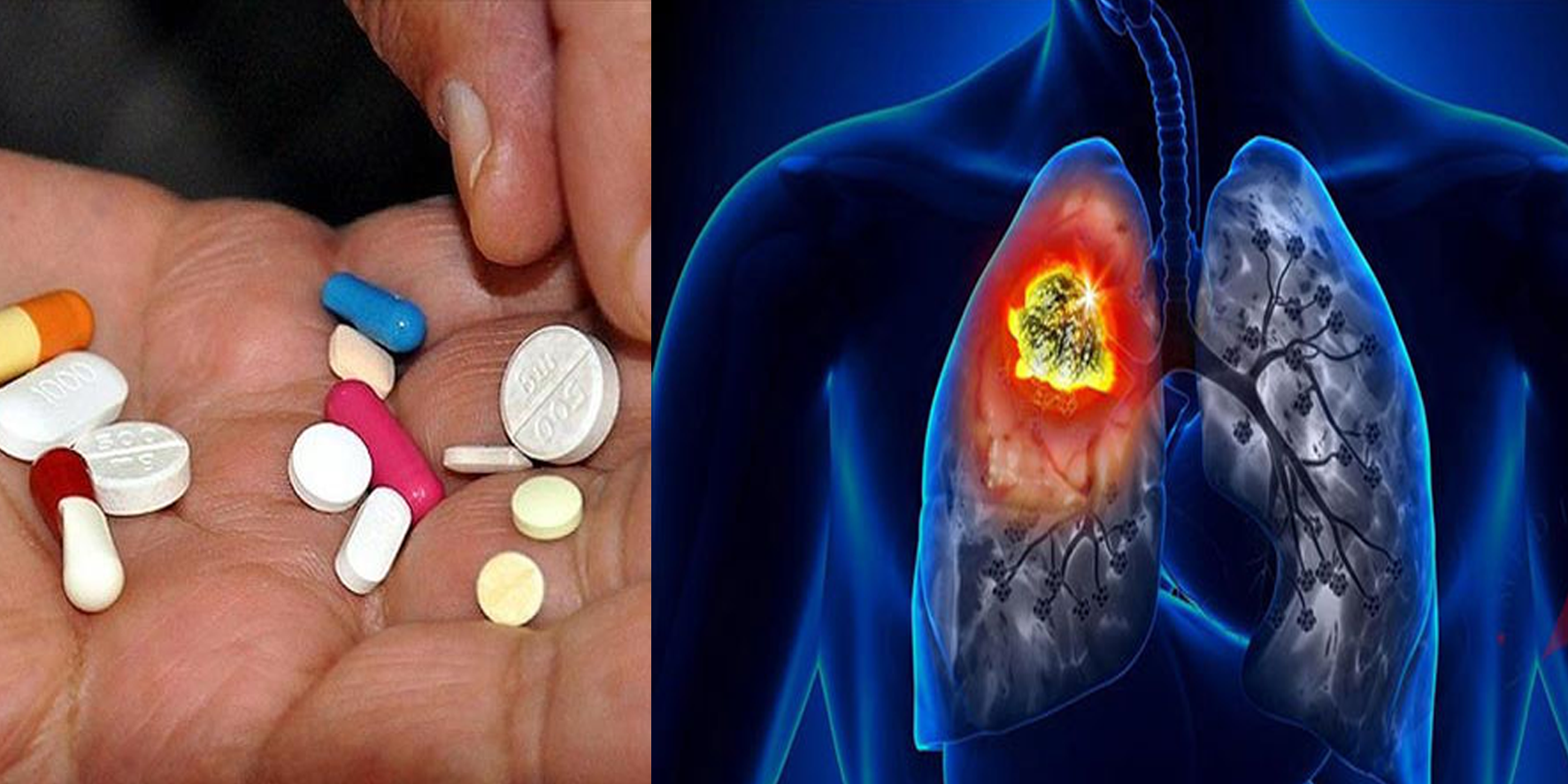 Onkoloji uzmanından uyarı: Vitamin ilacı kullanımı akciğer kanserini tetikliyor!