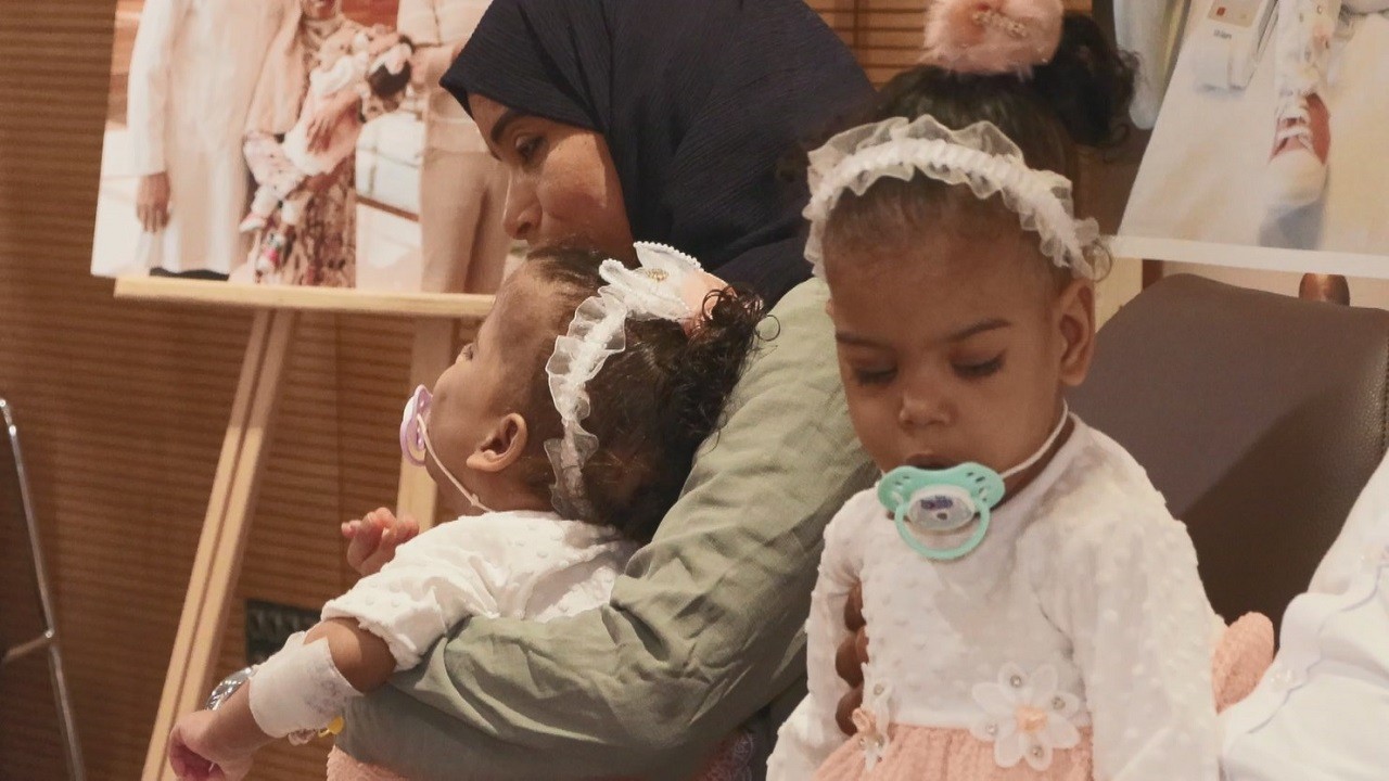 Operasyon 9 saat sürdü! Cezayirli yapışık ikizler Türkiye'de ayrıldı