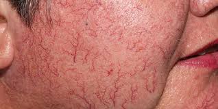 Örümcek damar ve varisli damarlarla mücadelede 8 doğal çözüm: Eski dönemi tarifine ait! İyi yapan tarifini yapın