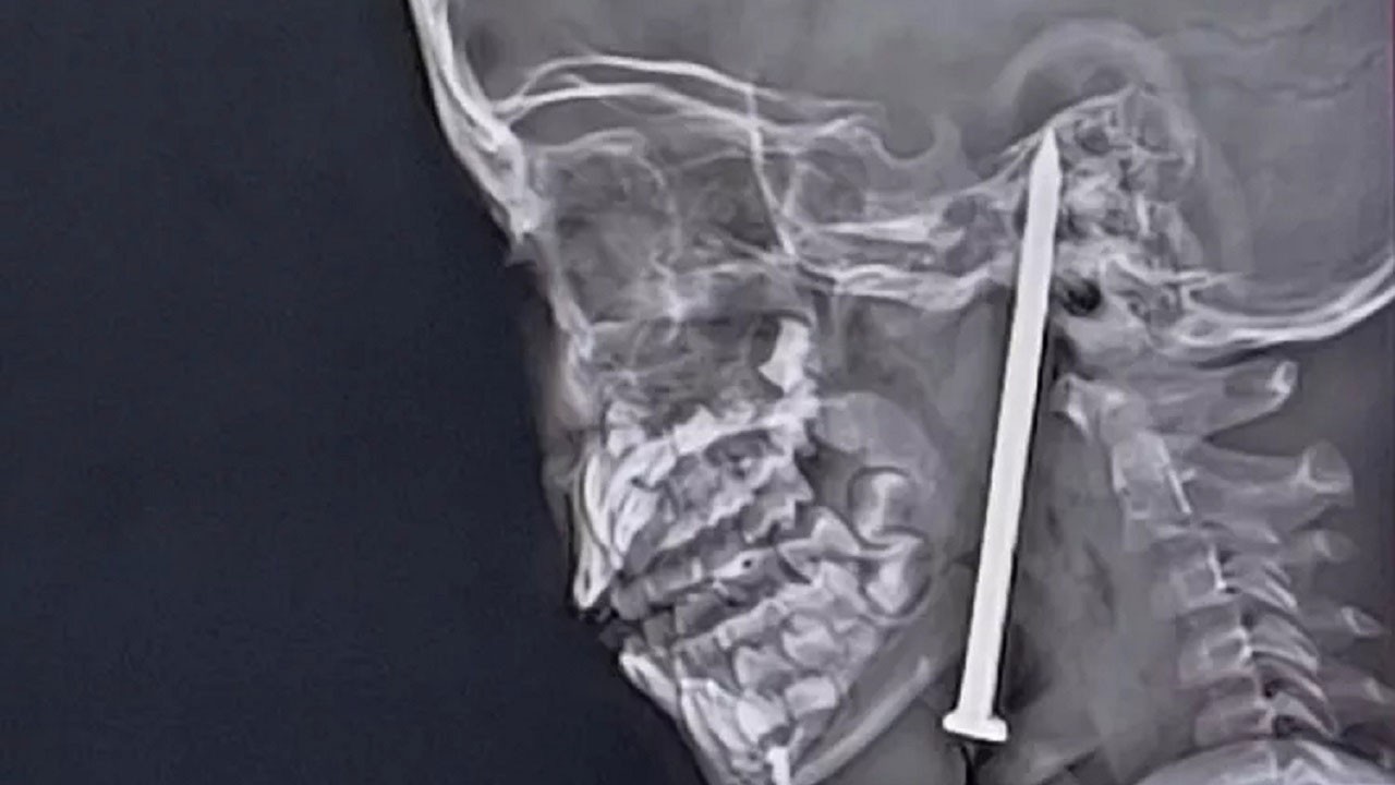 Oyun oynarken başına çivi saplandı! 7 yaşındaki çocuk ölümden döndü