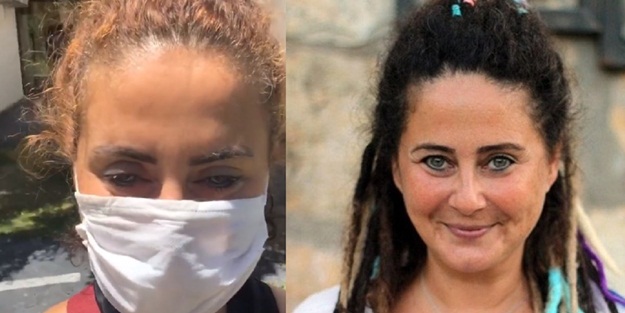 Oyuncu Esra Akkaya 'maske' hastalığına yakalandı! Gözleri şişti
