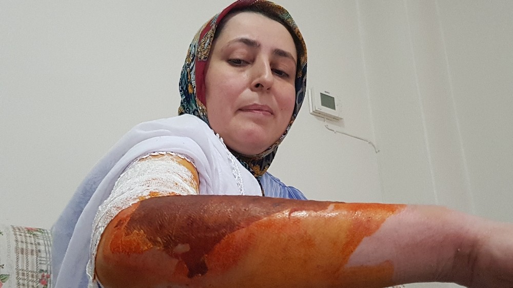 (Özel) Cani koca misafirin yanında oturmadı diye eşini kaynar su ile haşlandı 