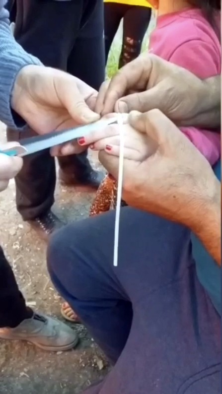 (Özel) İstanbul’da parmağını sıkıştıran küçük kıza maket bıçaklı müdahale 