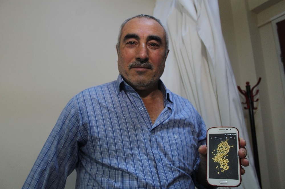 (Özel) Mesanesinden 199 adet nohut büyüklüğünde taş çıktı 