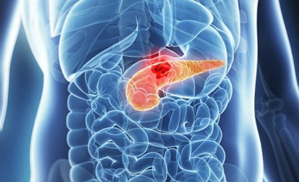 Pankreas kanseri aniden beliriyor