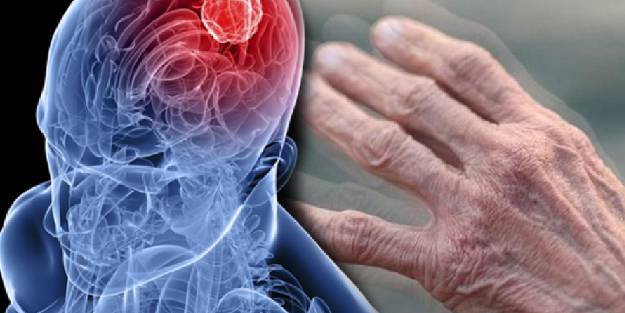 Parkinson hastalığı dünyada giderek artıyor