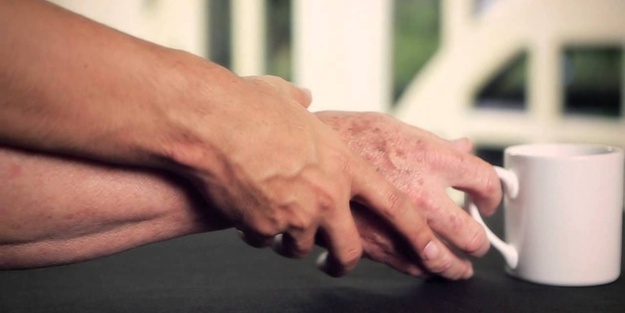 Parkinson hastalığının 4 belirtisi