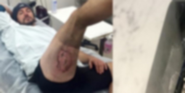  Patlayan iPhone bakın adamı ne hale getirdi