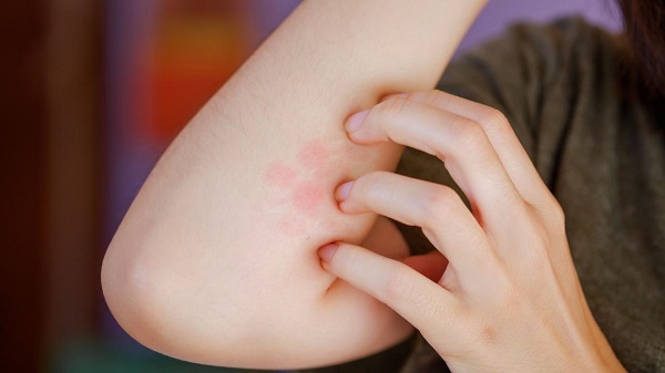 Pek çoğumuz önemsemiyoruz ama... Böcek sokması sonrası ölümden döndü!