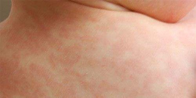 Pellegra’nın ilerisi erken bunama!