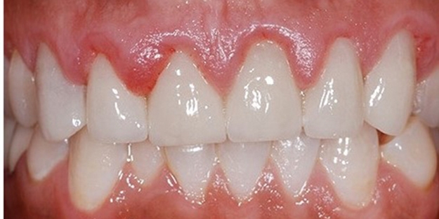 Periodontoloji Uzmanı uyardı: Çekilen diş eti eski haline gelmez!