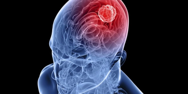 Pıhtı atması nedir? Belirtileri nelerdir?