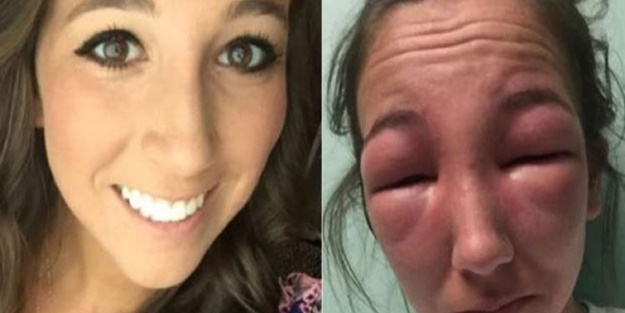 Pikniğe gitti, gözlerini kaybetti!