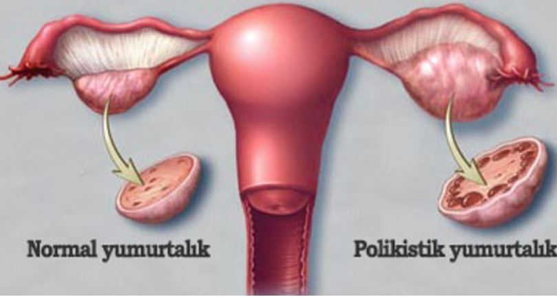 Polikistik over sendromu belirtileri nelerdir?