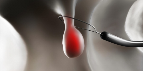 Polip nedir, kalın bağırsak polipleri nasıl tedavi edilmelidir?