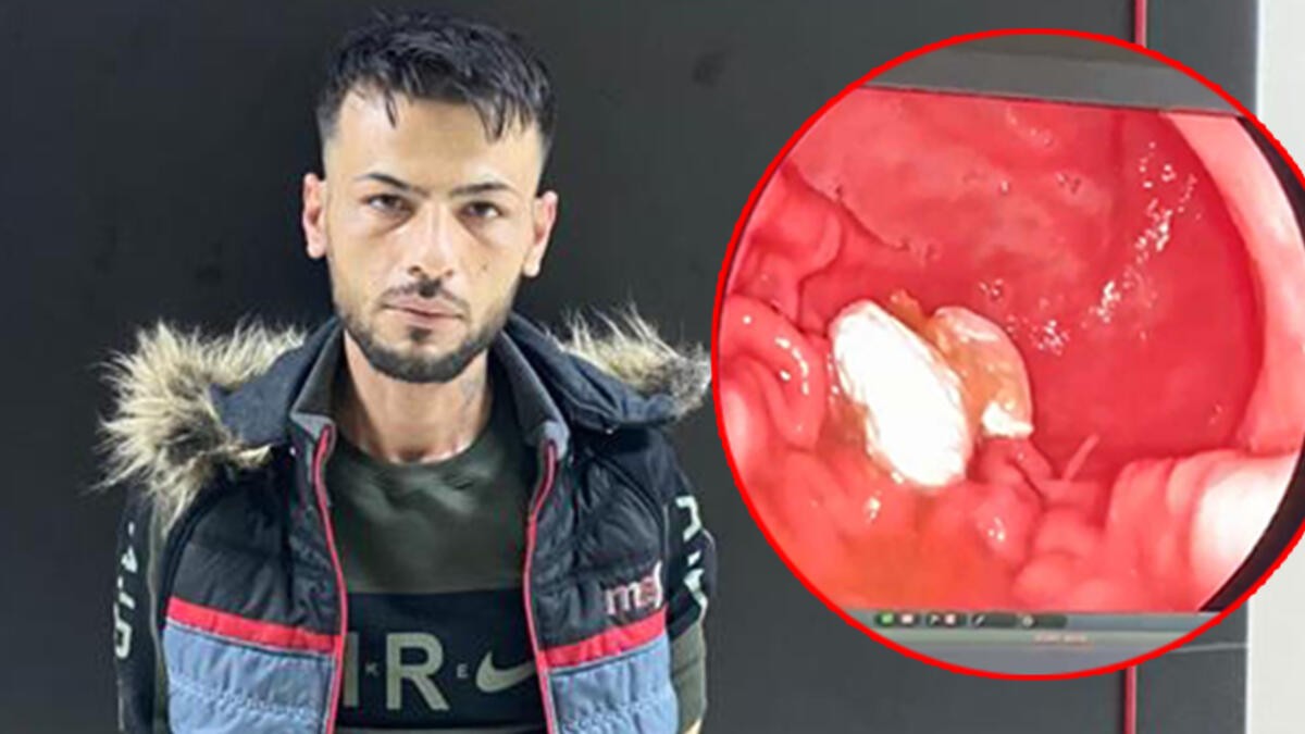 Polise yakalanmamak için yuttuğu eroin midesinden çıkarıldı