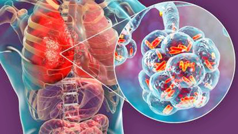 Polonya'da lejyonella bakterisinde durum ağırlaşıyor