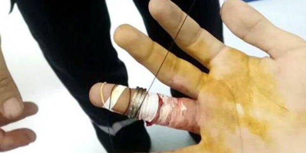 Potaya takılan yüzük hastanelik etti!