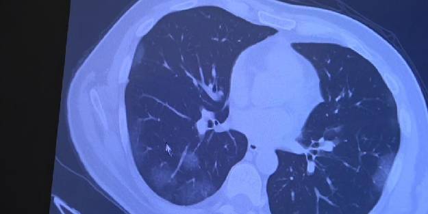 Profesör ilk defa açıkladı: Aşı olanlarda 'omicron' akciğere inmiyor