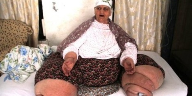 Elefantiyazis hastalığı nedir? Tedavisi nelerdir?