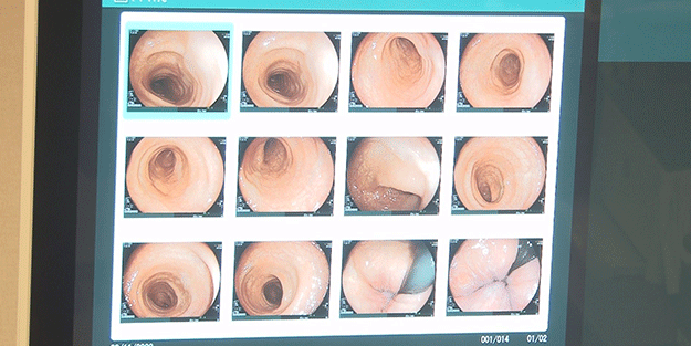 Reflüsü olanlara uzman uyarısı! Bu belirtileri olanlar dikkat