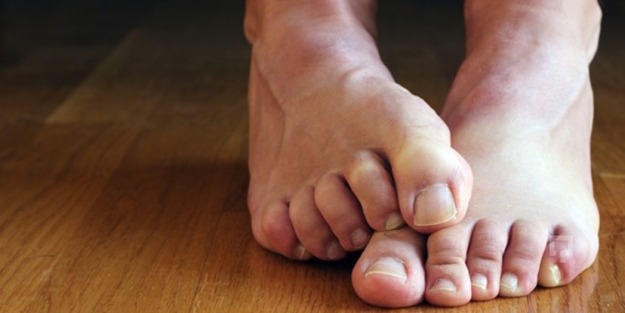 Reynaud sendromu nedir?