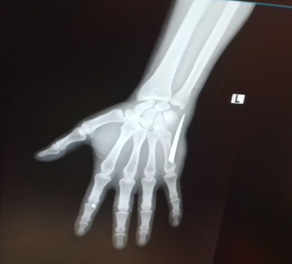 Röntgen çekilince hayatının şokunu yaşadı