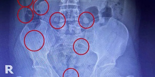 Röntgende ortaya çıktı!