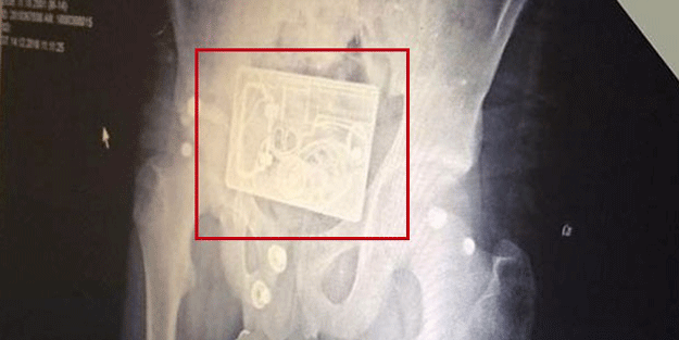 Röntgene bakanın kanı dondu… Hastanede büyük panik