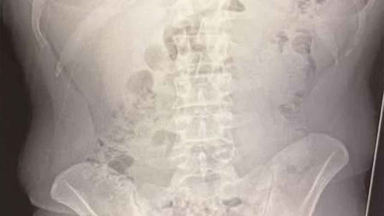 Röntgeni çeken doktorlar gözlerine inanamadı! Mide ve bağırsaklarından adeta ölüm saçıldı!
