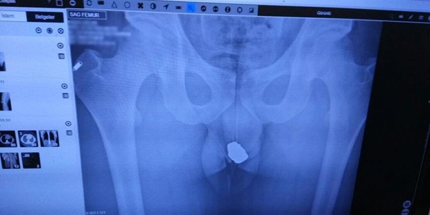 Röntgeni çekilince yakayı ele verdi